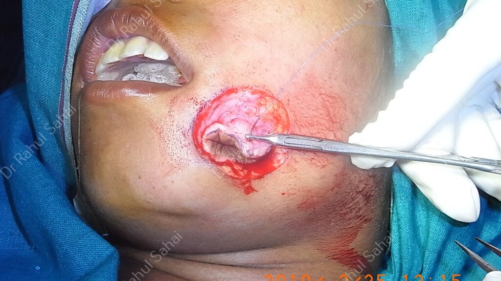 muscle layer with fat layer superimposed over the repaired lining